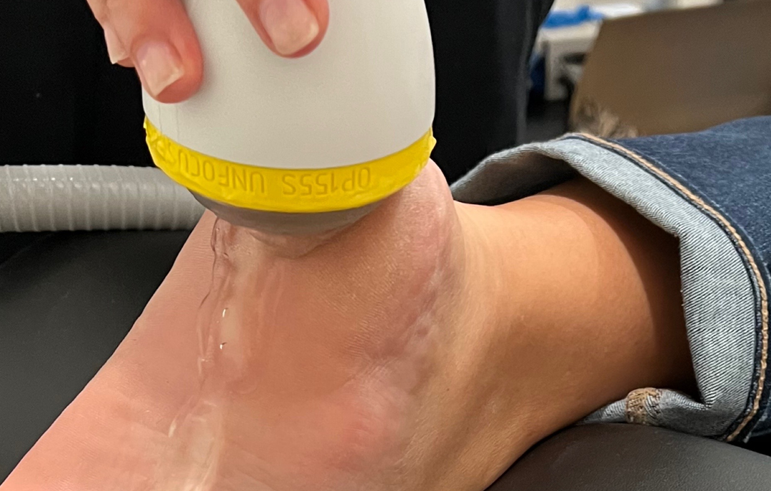 Achilles Tendonitis: A Path to Pain-Free Living with SoftWave Therapy