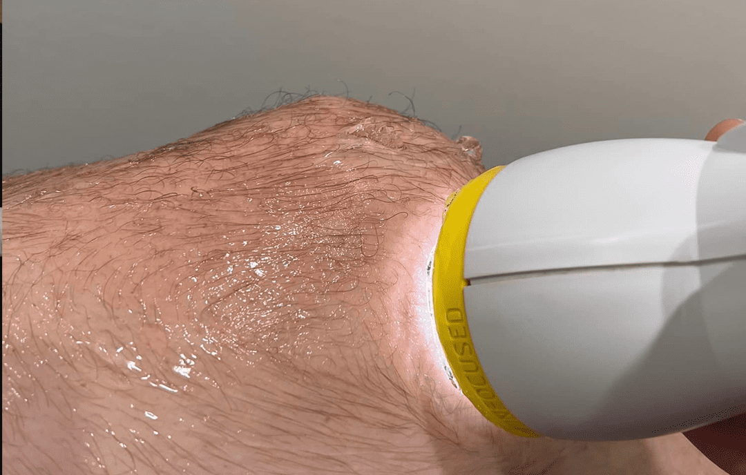 MCL Injuries: Finding Hope and Healing with SoftWave Therapy